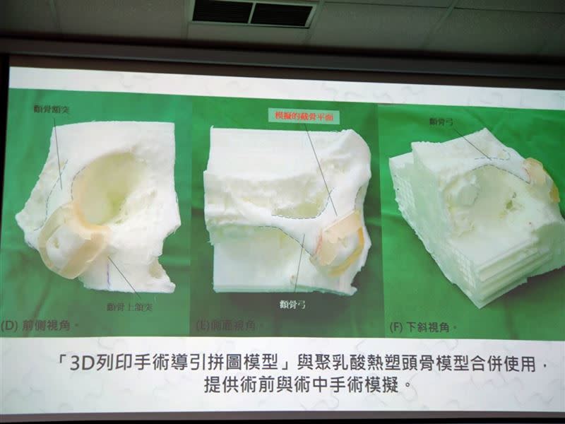 台北榮總首度以3D列印技術製作導引拼圖模型，成功幫陳小弟完成微創手術（圖／記者黃仲丘攝影）