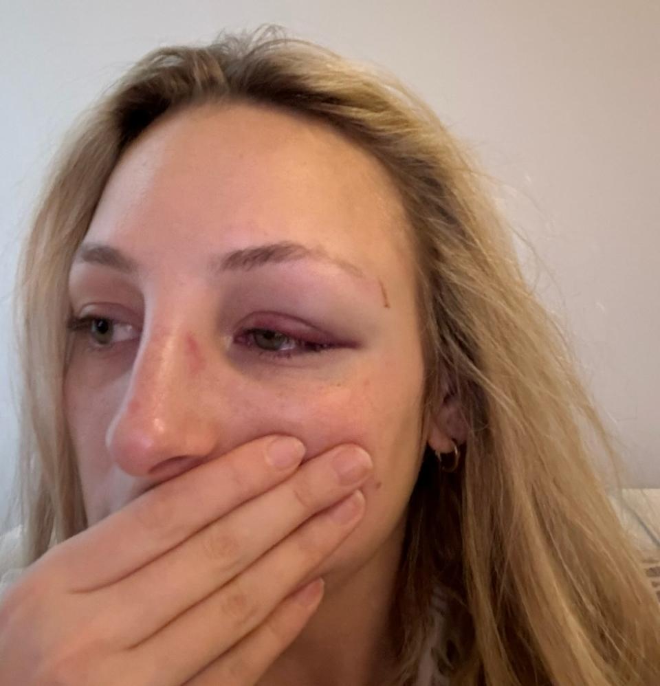 Jill Burke suffered a black eye and concussion when she was assaulted in Union Square on January 31. Courtesy of Jill Burke