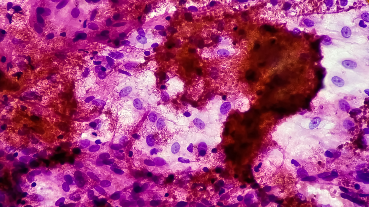 Tuberculosis close-up in purple and red