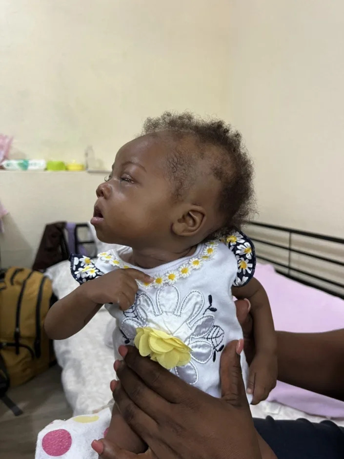 Nadie, while in Haiti at 6 months old, was just 7 pounds and her eyes were nearly closed as she suffered from conjunctivitis.