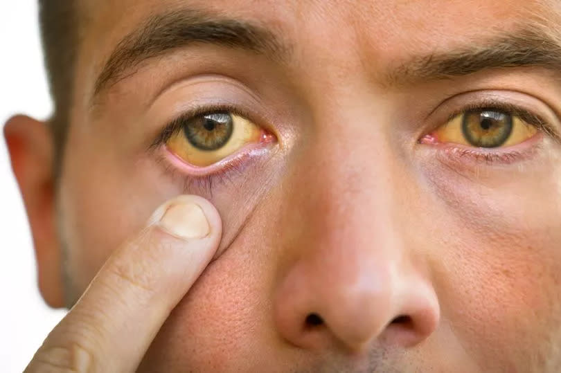 Young man with jaundiced eyes and skin, which can be signs of a serious infection