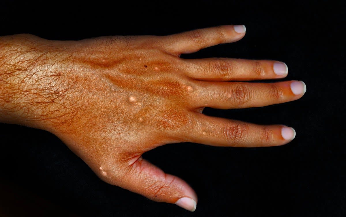 Monkeypox causes skin lesions such as blisters, which emerge between one to five days after other symptoms  (Alamy/PA)
