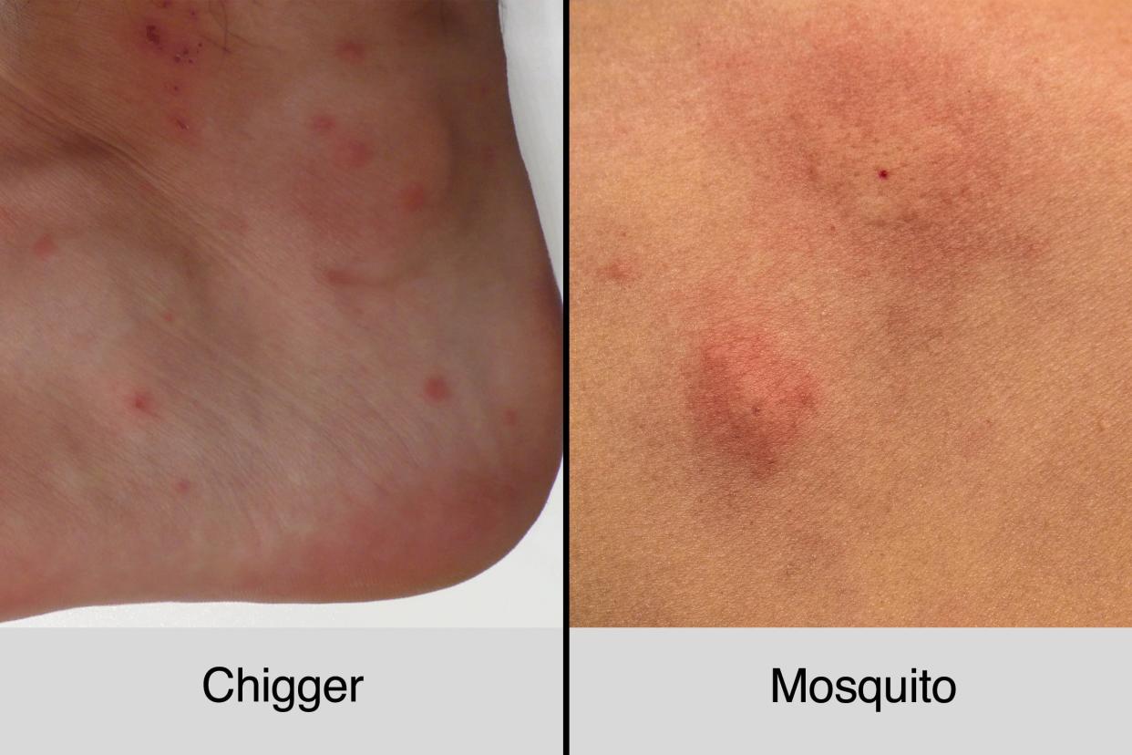 chigger bites vs mosquito bites