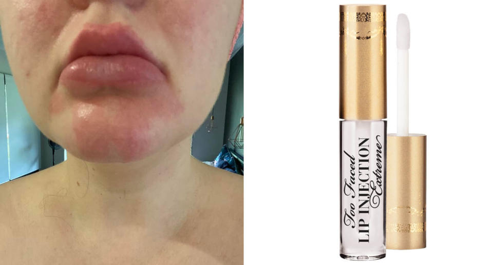 Woman with rash on lips and chin  from using Too Faced Lip Injection Extreme