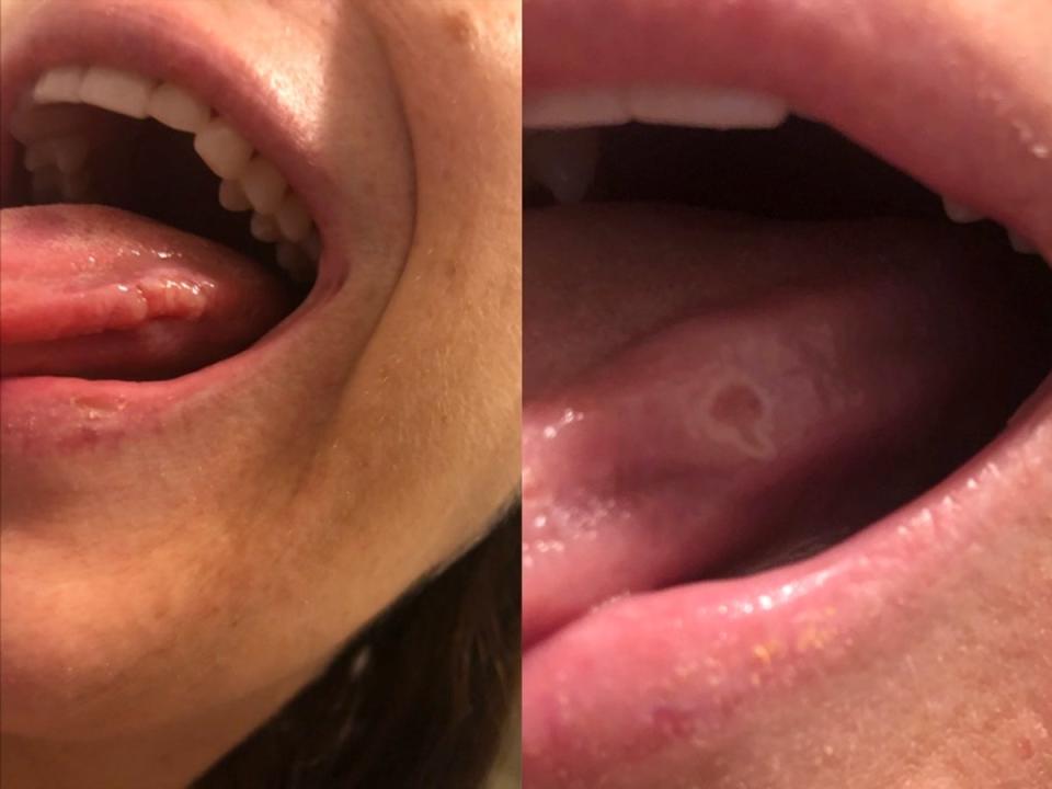 Roban Lampkin found sores on the inside of her mouth and tongue that made it hard to speak (Courtesy of Roban Lampkin)