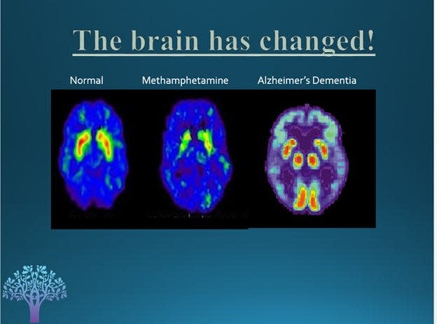 Dr. Moran includes this slide when he explains addiction to the families of his patients. The PET scan shows less brain activity, highlighted by injected dye, in the individual with Alzheimer’s and even less activity in the methamphetamine user. The person with addiction can recover normal brain activity with time and treatment.
