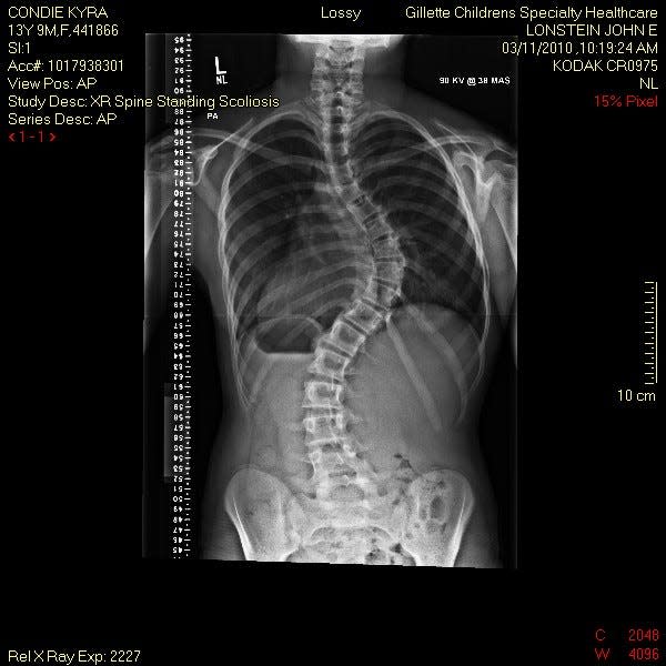 An X-ray of Olympic sport climber Kyra Condie's back, before she underwent spinal fusion surgery in 2010.