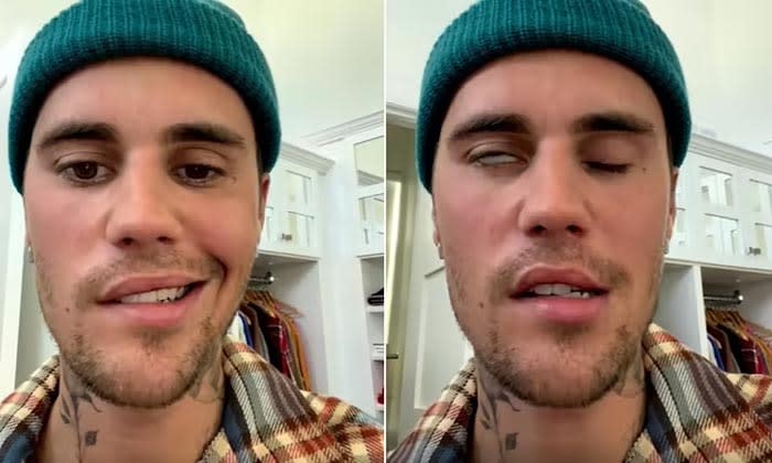 Justin Bieber sufre una parálisis facial