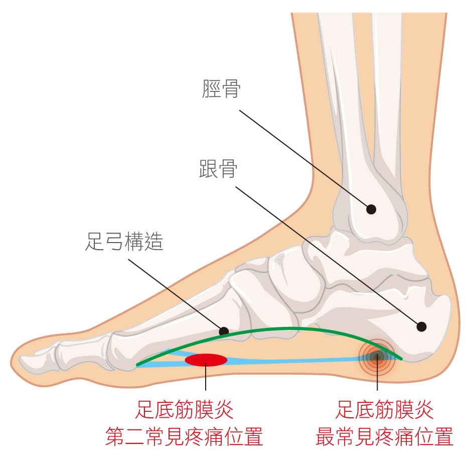 長時間走路可在鞋內加鞋墊，緩衝踩地的壓力。台北聯醫提供