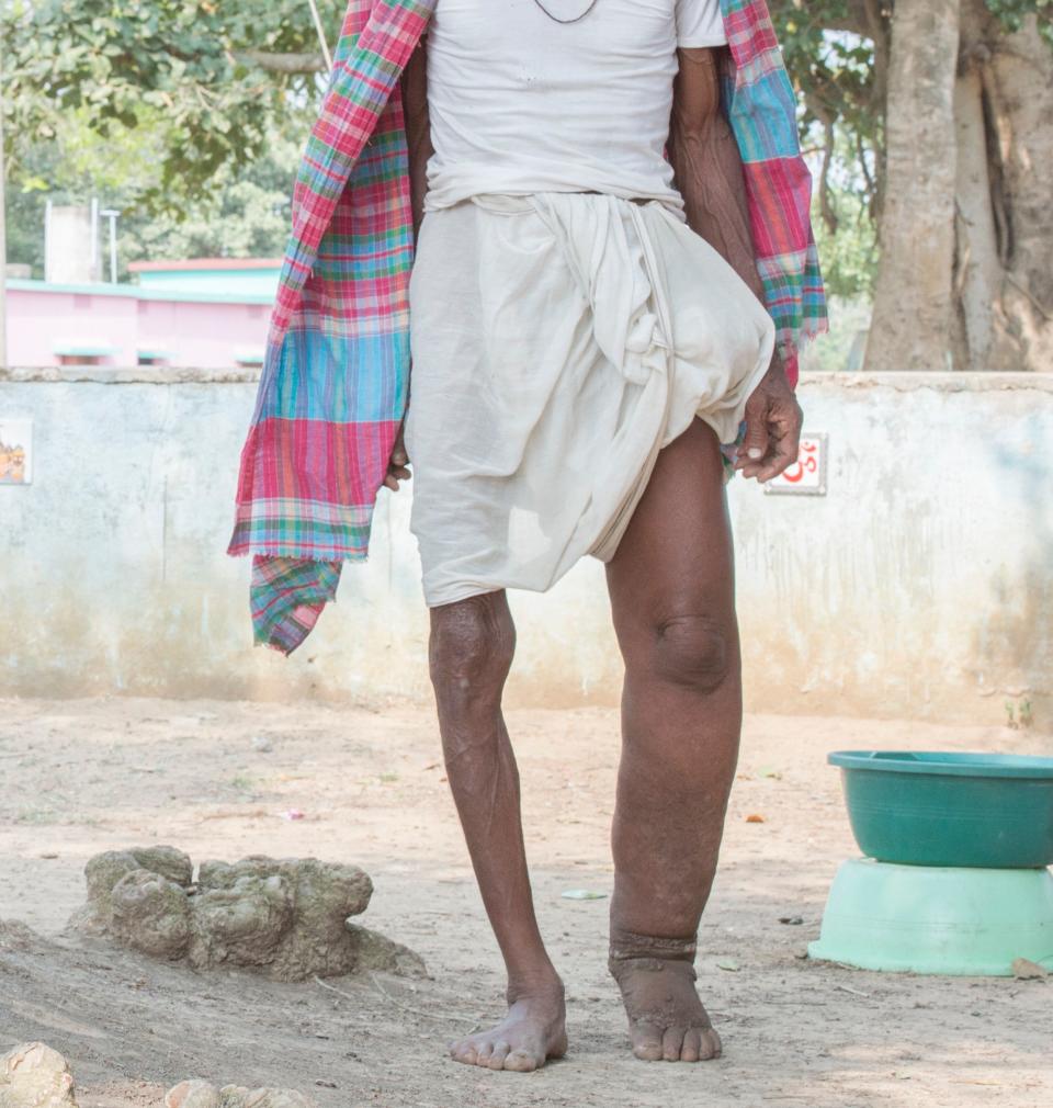 A man in India displaying symptoms of&nbsp;lymphatic filariasis, commonly known as elephantiasis, a neglected tropical disease that causes skin and tissue swelling. (Photo: DNDi / Maneesh Agnihotri)