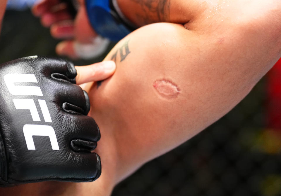 LAS VEGAS, NEVADA - MARCH 23: Detail view of a bite mark on the arm of Andre Lima of Brazil after his flyweight fight against Igor Severino of Brazil during the UFC Fight Night event at UFC APEX on March 23, 2024 in Las Vegas, Nevada.  Severino was disqualified for biting Lima in the second round. (Photo by Chris Unger/Zuffa LLC via Getty Images)