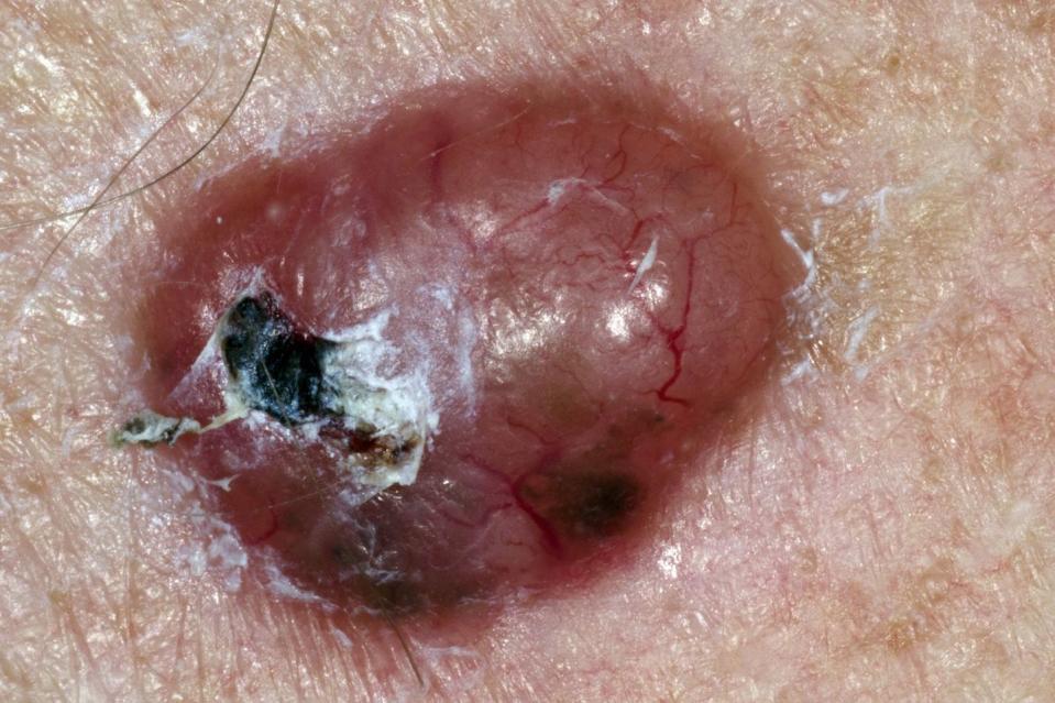 a lump on the skin to represent a sign of mon melanoma cancer