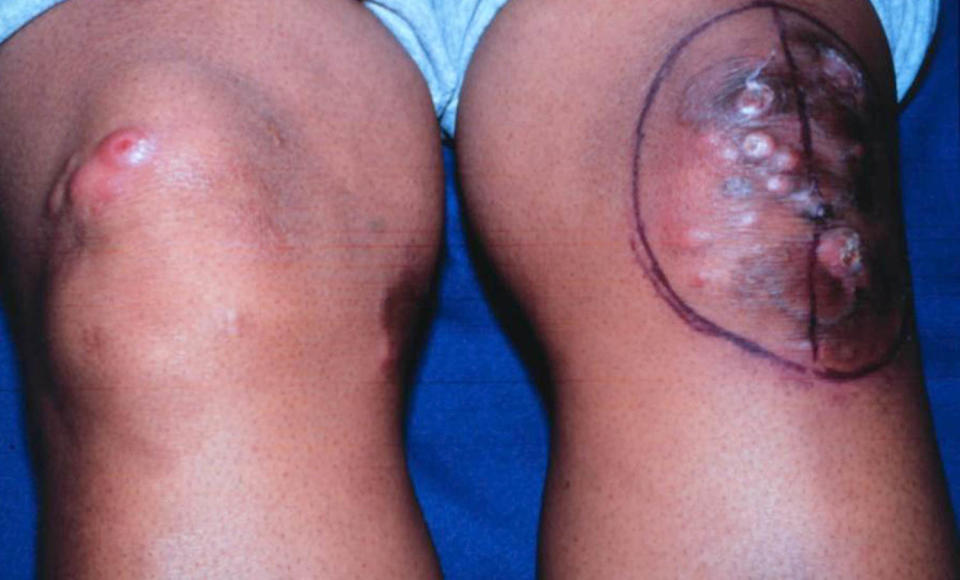 Nodules and tumors on a rash are signs of advanced CTCL. (NIH)