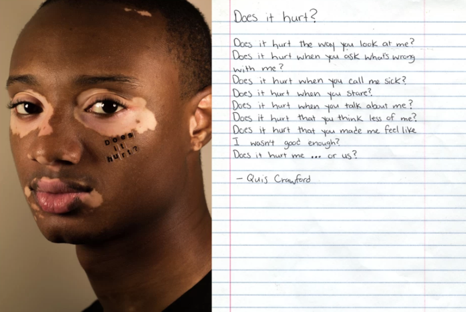 Quis Crawford is a model who doesn’t hide behind his vitiligo. (Photo: Peter DeVito)