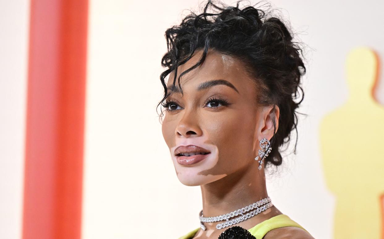 Winnie Harlow isn't hiding the vitiligo on her body in her latest magazine cover shoot. (Photo by Frederic J. Brown / AFP) (Photo by FREDERIC J. BROWN/AFP via Getty Images)