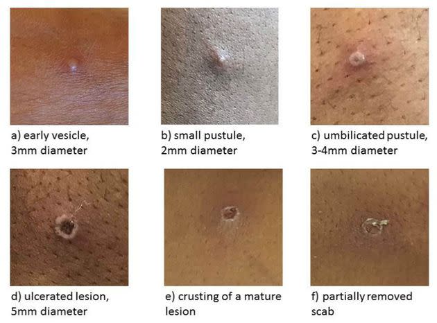 The stages of monkeypox lesions, according to the UKHSA (Photo: UK Health Security Agency via PA Media)