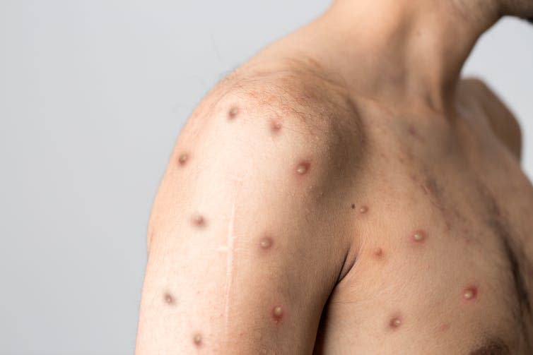 A young man with monkeypox. He has spots covering his arms and chest.