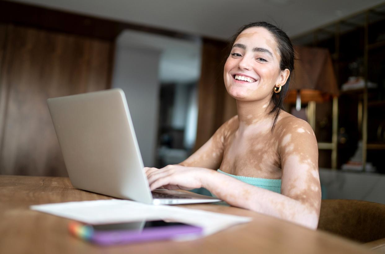 woman with vitiligo