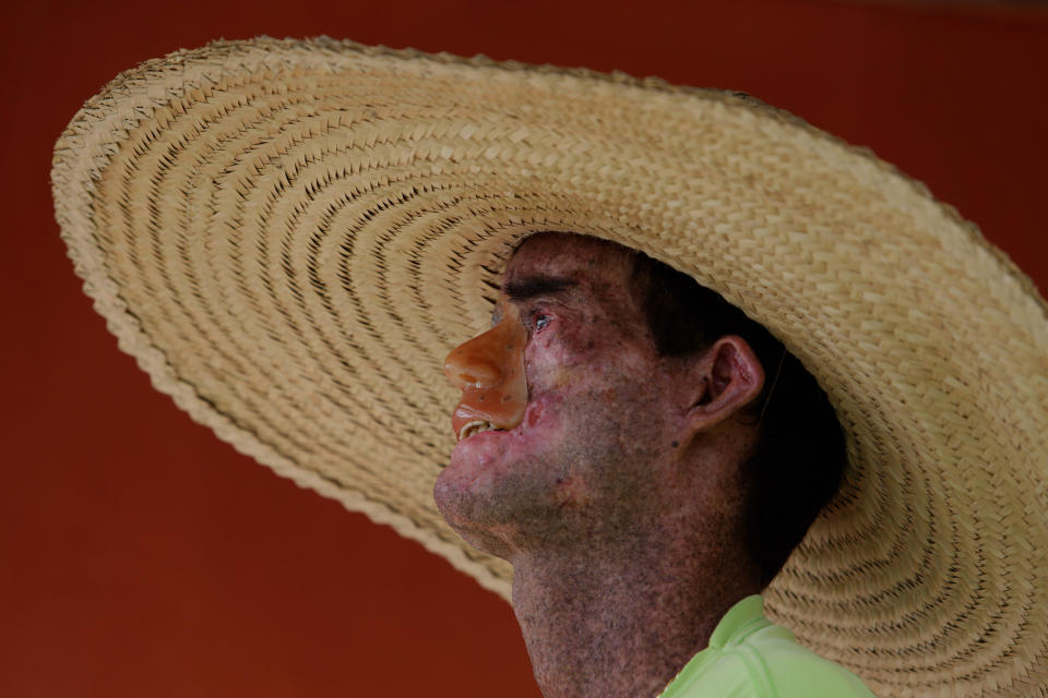 In this March 3, 2014 photo, Djalma Antonio Jardim, who has a rare inherited skin disease known as xeroderma pigmentosum, or "XP," looks out the window from inside his home in the Araras community of Brazil's Goias state. Jardim wears the large straw hat in an effort to protect his face, but it's helped little, as he has undergone more than 50 surgeries to remove skin tumors. (AP Photo/Eraldo Peres)