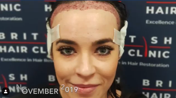 Screengrab of Stephanie Davis from British Hair Clinic Instagram