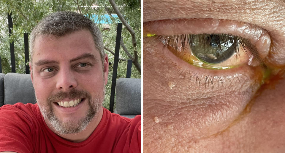 Man named Stuart Vesty in red t-shirt with beard (left) Close up photo of eyeball with green liquid after spider bite (right)