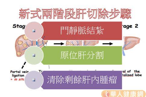 新式2階段肝切除，讓轉移性腸癌患者重拾生存希望。（圖片提供／成大附醫）