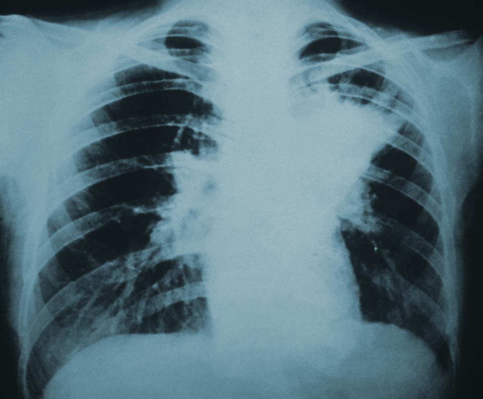 A chest Xray shows heavy inflammation inside a set of lungs caused by a blastomycosis infection.