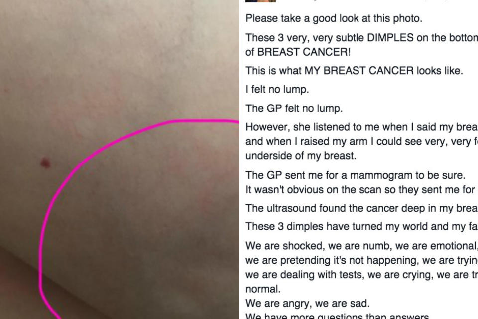 This woman posted a photo of her breast cancer as a warning for everyone