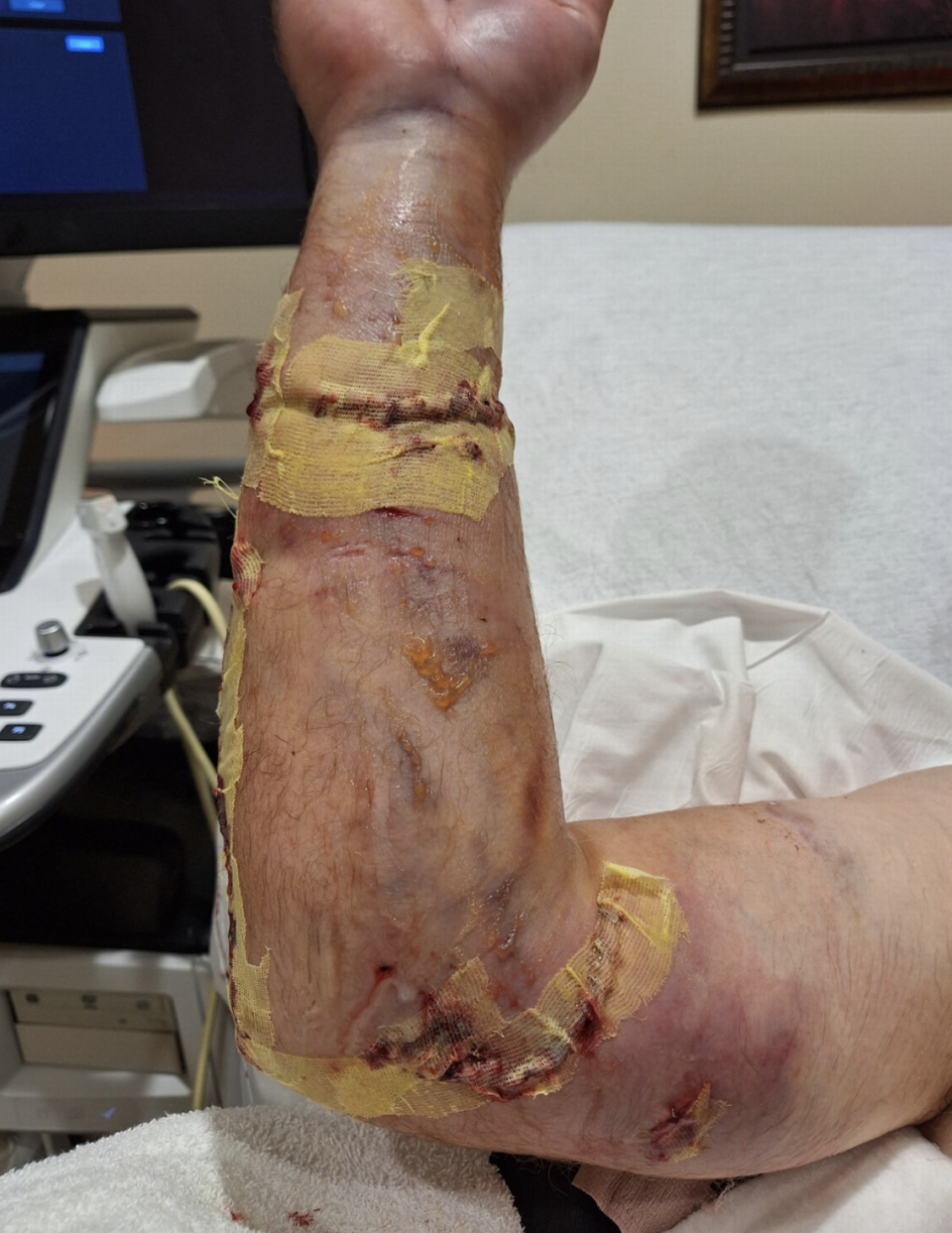 William Georgitis’ ulna was snapped in half and his radius fractured in shark attack near Charleston, SC.