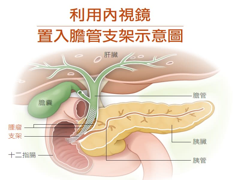 內視鏡置入膽管支架示意圖