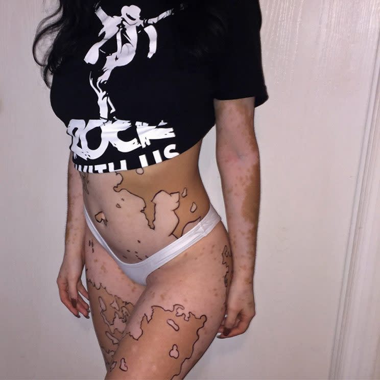 A woman with vitiligo shows off her skin color differences, highlighted with black outlines.