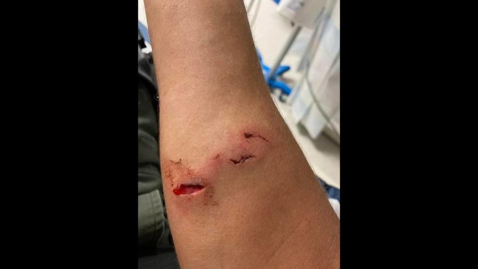 This is a photo of the wounds suffered by an Alabama deputy during a 20-minute brawl with a suspect in Walker County, officials say.