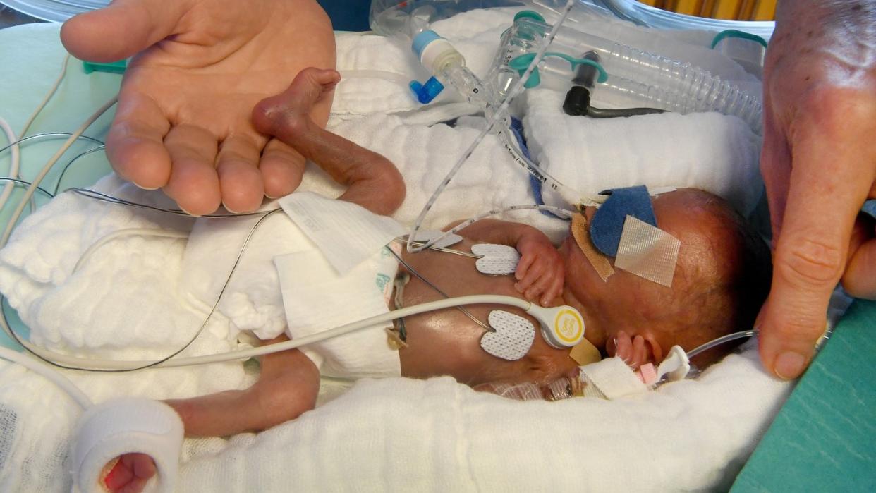 In der Hand einer Pflegekraft liegt der Fuß eines fünf Tage alten und bei der Geburt 430 Gramm wiegenden Jungen in der Kinderklinik der Medizinischen Hochschule Hannover. Frühchen sind die größte Patientengruppe im Kindesalter. Foto: Holger Hollemann/Archiv