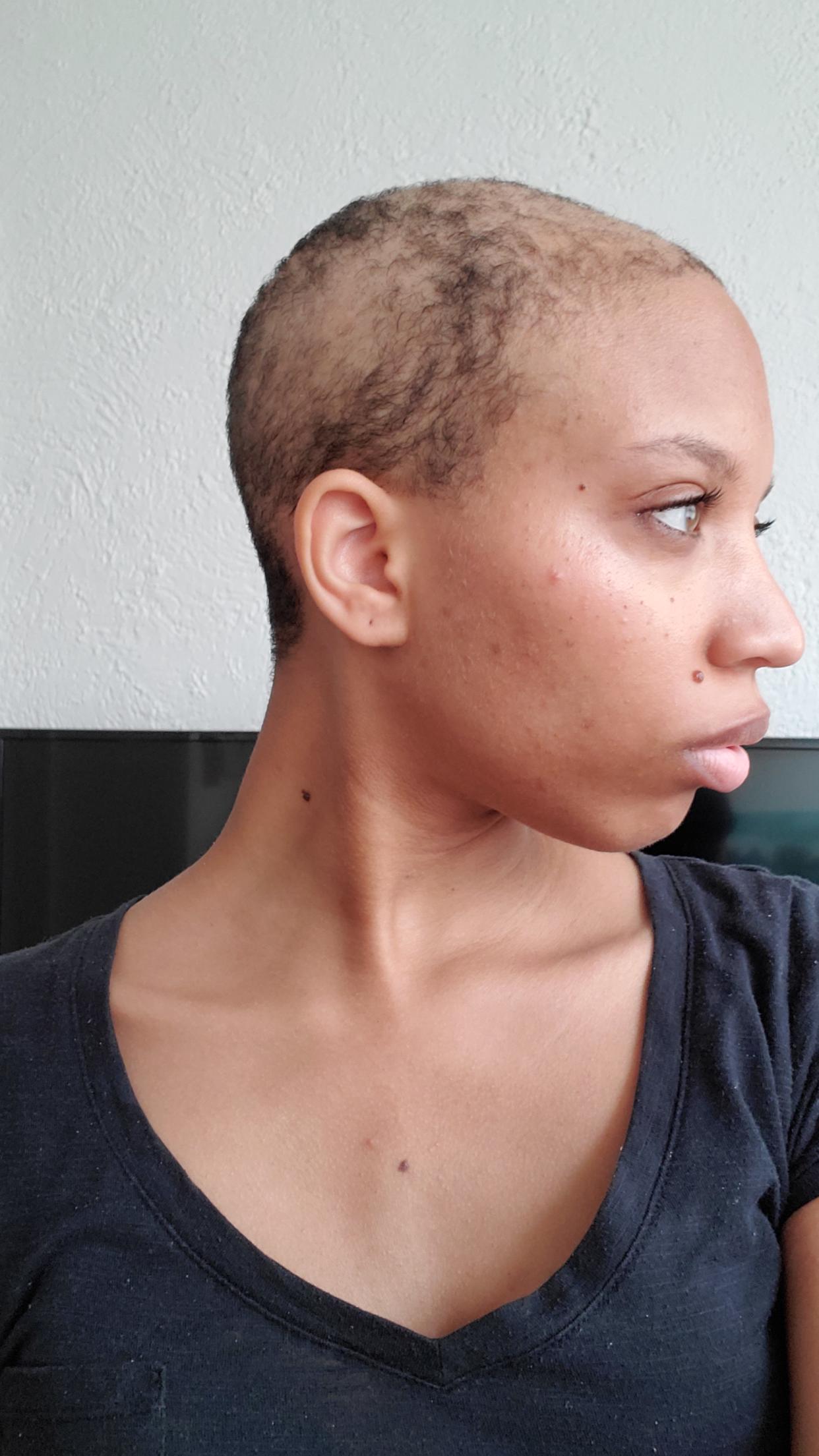 Woman with hair loss caused by trichotillomania.