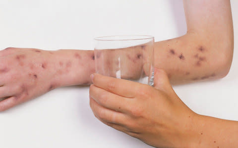 Meningitis glass test: a glass held on child's arm covered in purple rash - Credit: Gary Ombler/Dorling Kindersley