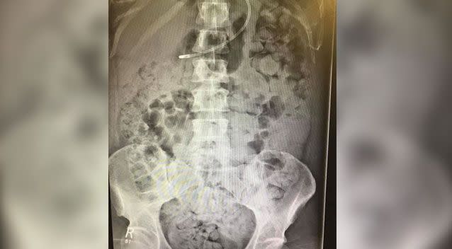 An X-ray image shows the alarming extent as to how much excrement is inside her. Source: GoFundMe