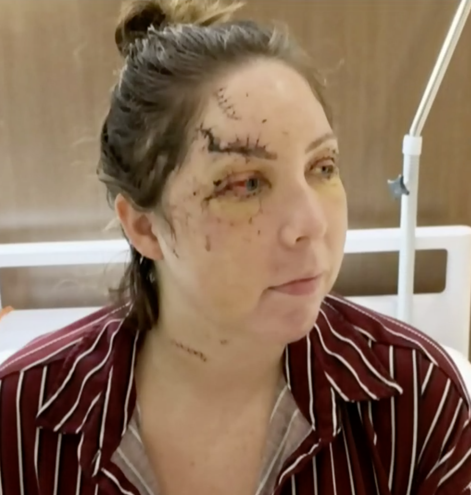 Woman shown after surgery for injuries sustained in brutal hotel bashing in Mexico. 