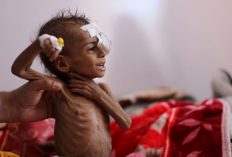 FILE PHOTO: Child malnutrition at record highs in parts of Yemen -U.N. survey