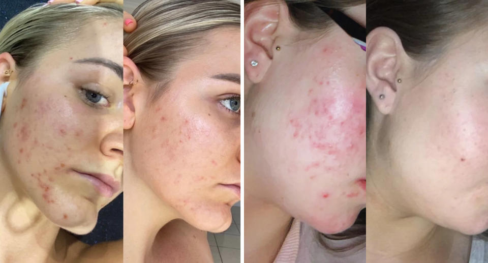 Before and after photos of skin with acne