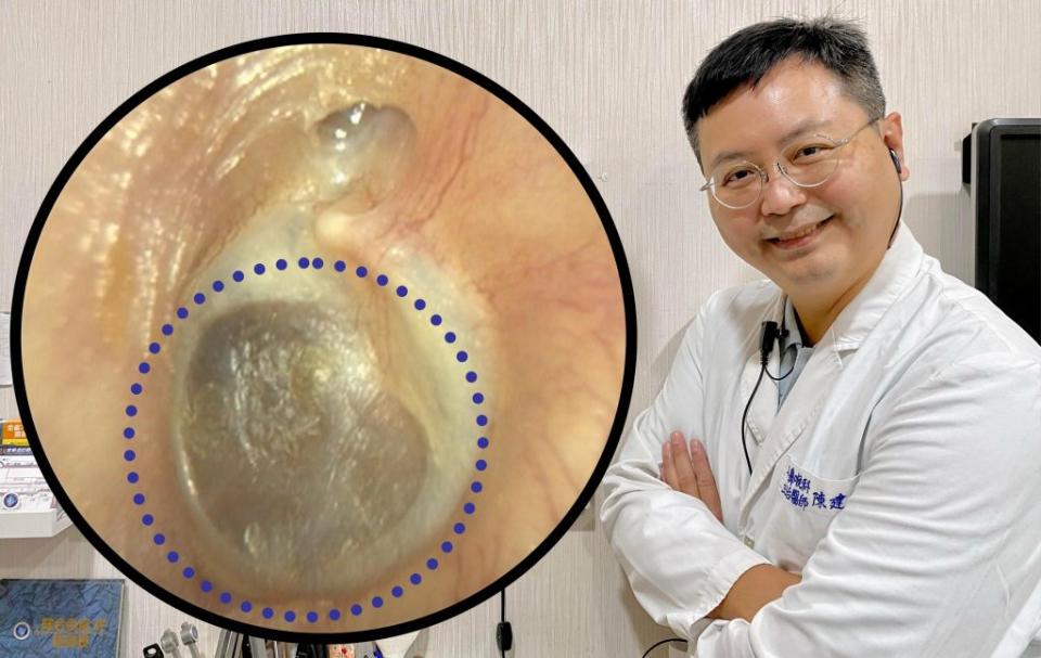 醫師陳建志說明耳膜鬆弛症，藍色圈處為發生病變處。（醫師陳建志提供）