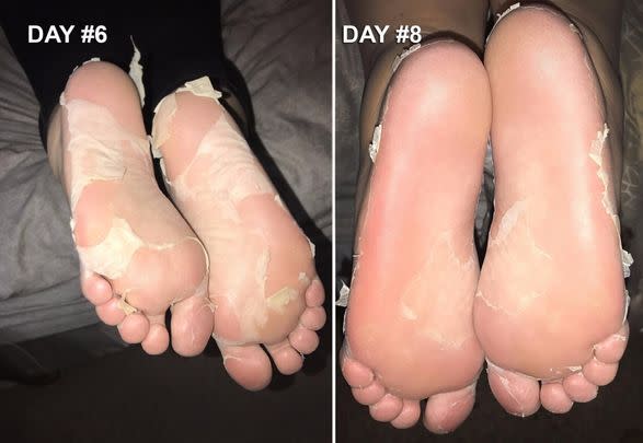 Foot-exfoliating peel masks