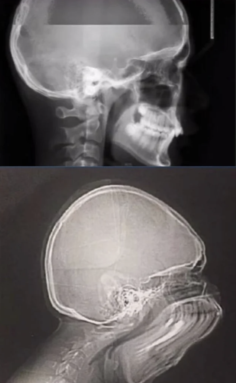 An x-ray of someone sneezing