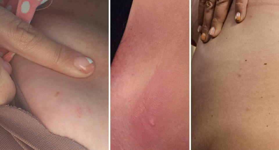 Red bite marks on her legs (left and middle) and on her side (right). 