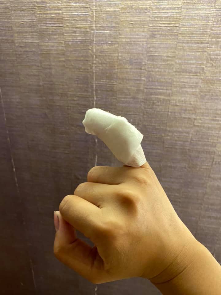 一名女遊客的右手小指遭15公分大的蜈蚣咬傷。（圖／翻攝自「好想住飯店⭕好康.踩雷不藏私」臉書社團）