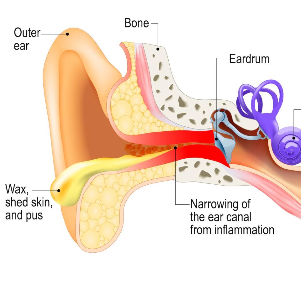 An illustration showing inflammation and narrowing of the ear canal. <a href="https://www.gettyimages.com/detail/illustration/swimmers-ear-otitis-externa-royalty-free-illustration/1003084366?adppopup=true" rel="nofollow noopener" target="_blank" data-ylk="slk:ttsz/iStock via Getty Images Plus;elm:context_link;itc:0;sec:content-canvas" class="link ">ttsz/iStock via Getty Images Plus</a>