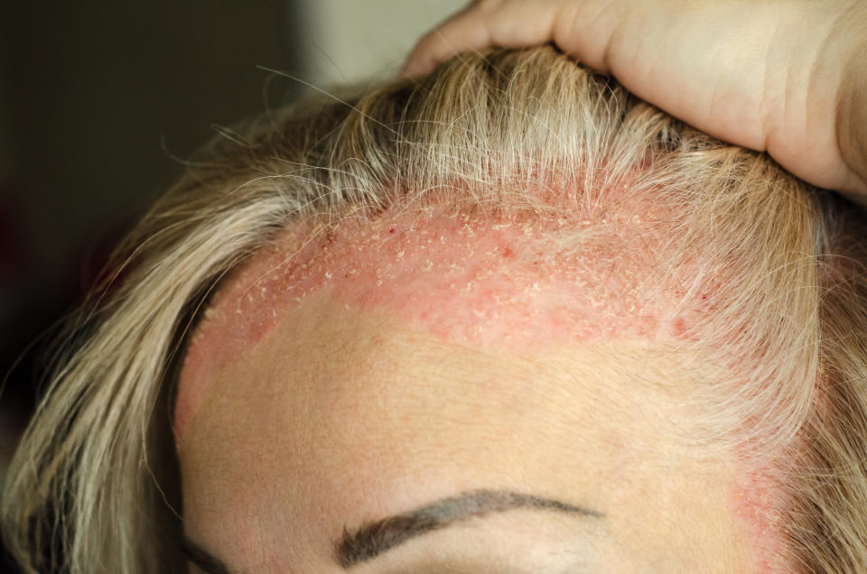 Psoriasis can show up on a patient's scalp. (Photo via Getty Images)