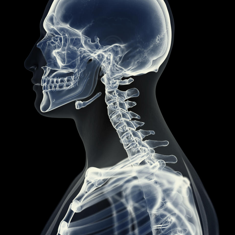 Chordoma typically starts in either the skull or the spine. (Photo via Getty Images)