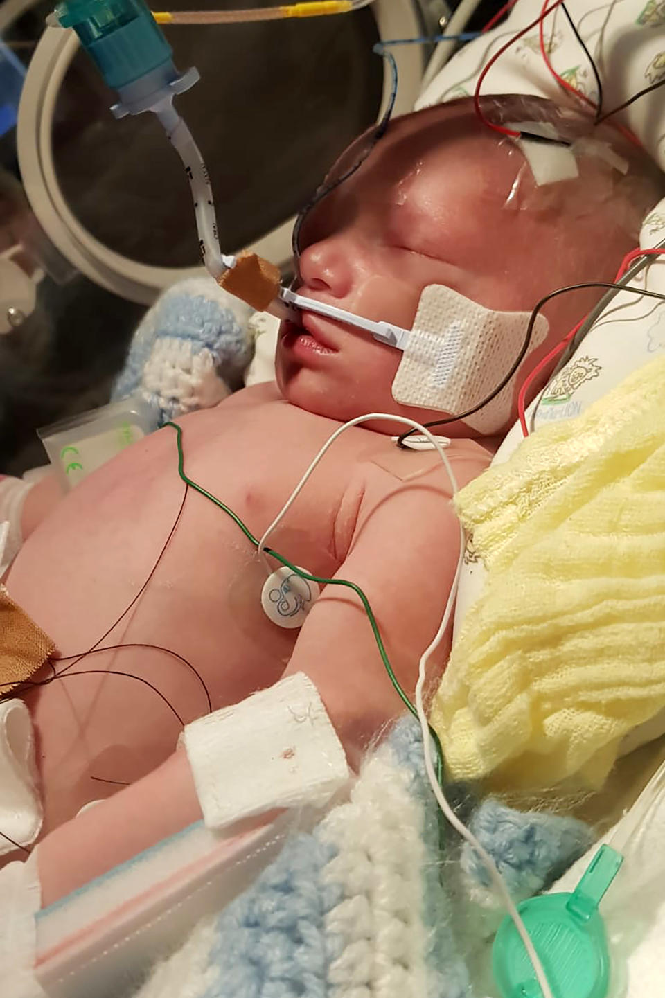 Logan was diagnosed with Alagille syndrome shortly after his birth in December 2018. (Caters)