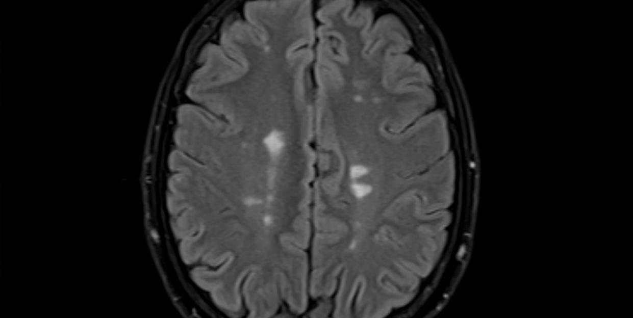 magnetic resonance imaging of multiple sclerosis in brain, axial flair view