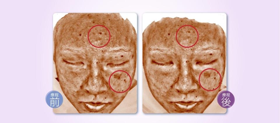 完成You Medical Beauty速效皮秒碎斑療程1次後，「AI智能光譜皮膚檢測」即時全方位顯示效果（紅圈位置）。